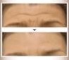 botox7